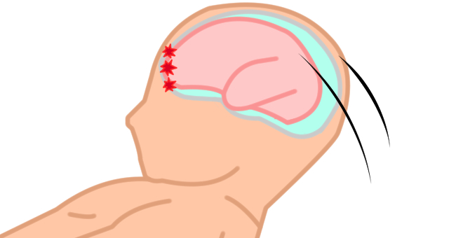 後頭部強打後の反動衝撃